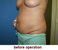 plastic-surgery-tummy-tuck